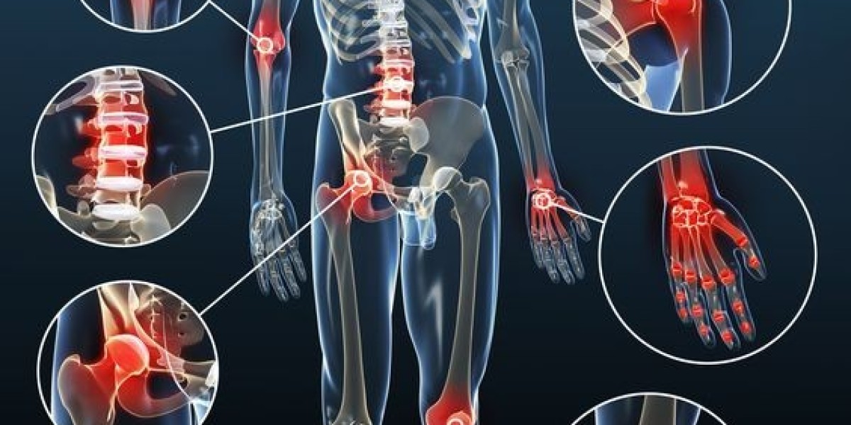 Expert Strategies for Neuropathic Pain Relief