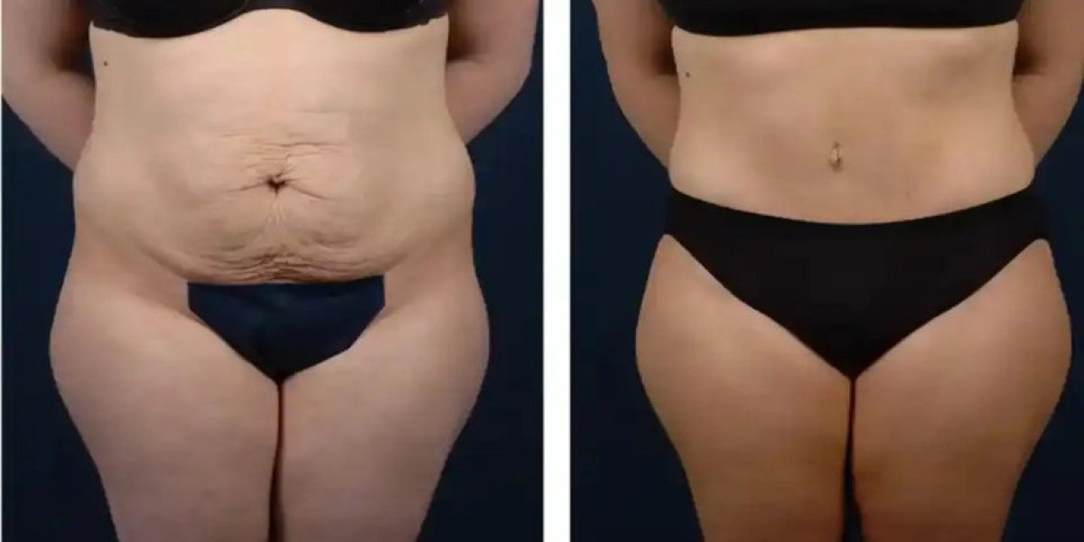 Tummy Tuck for Men: What You Need to Know About Male Abdominoplasty