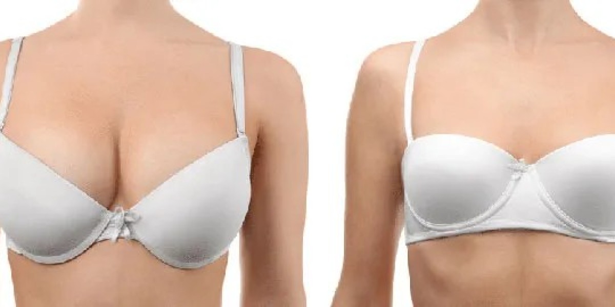 Am I a Candidate for Breast Reduction Surgery?