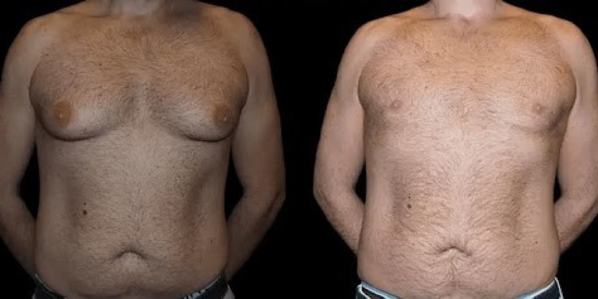 Innovations in Male Breast Reduction: New Techniques and Technologies